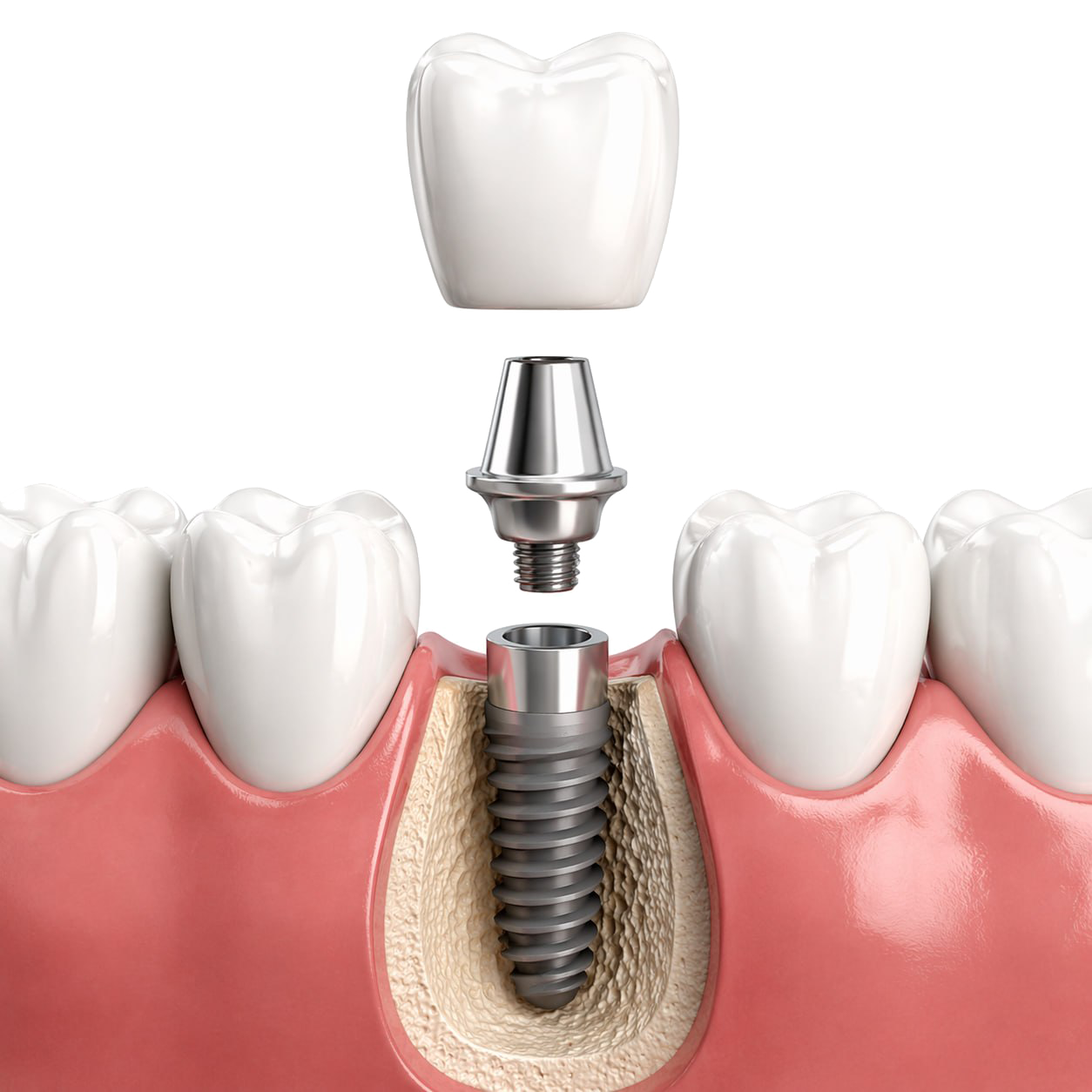 Немецкий имплант по доступной цене